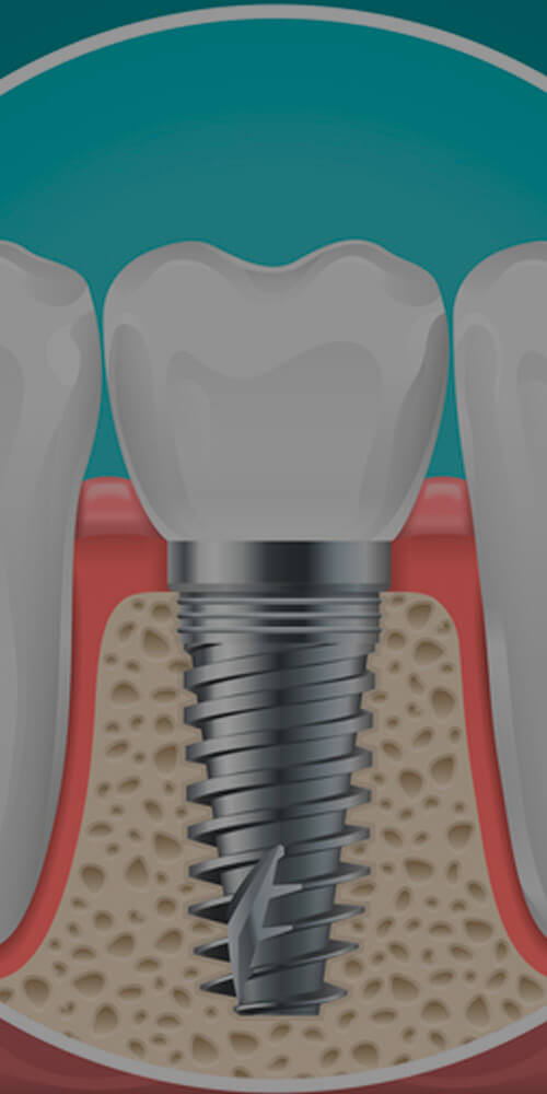 Clínica de Implantes Dentários em Brooklin Paulista