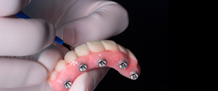 Implante tipo Overdenture Brooklin