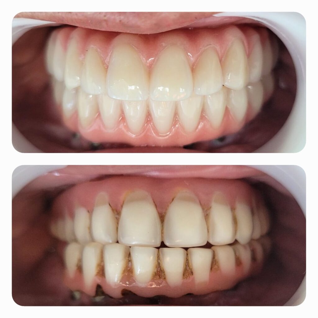 PRÓTESE PROTOCOLO ANTES E DEPOIS