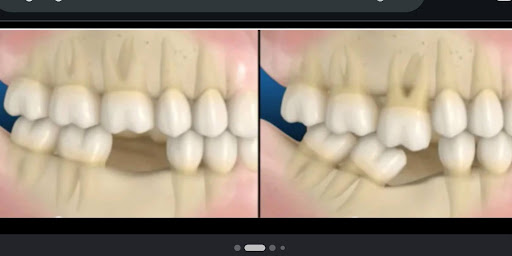 Ilustração 3D de dente inferior ausente mostrando dentes vizinhos entortando para o espaço vazio. Odonto Caprio no Brooklin.
