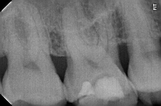 Radiografia dentária detalhando um dente fraturado com restauração profunda. Tratamento de emergência na Odonto Caprio no Brooklin.