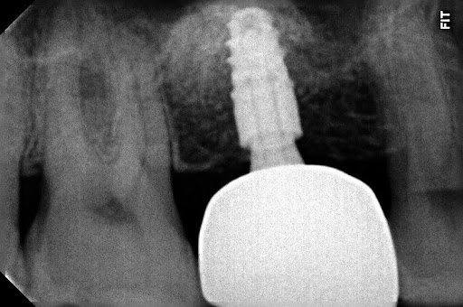 Radiografia de implante dentário e coroa finalizados, perfeitamente integrados ao osso. Tratamento na Odonto Caprio no Brooklin.