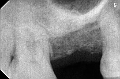 Radiografia mostrando espaço vazio e reabsorção óssea três meses após extração dentária. Clínica Odonto Caprio no Brooklin.